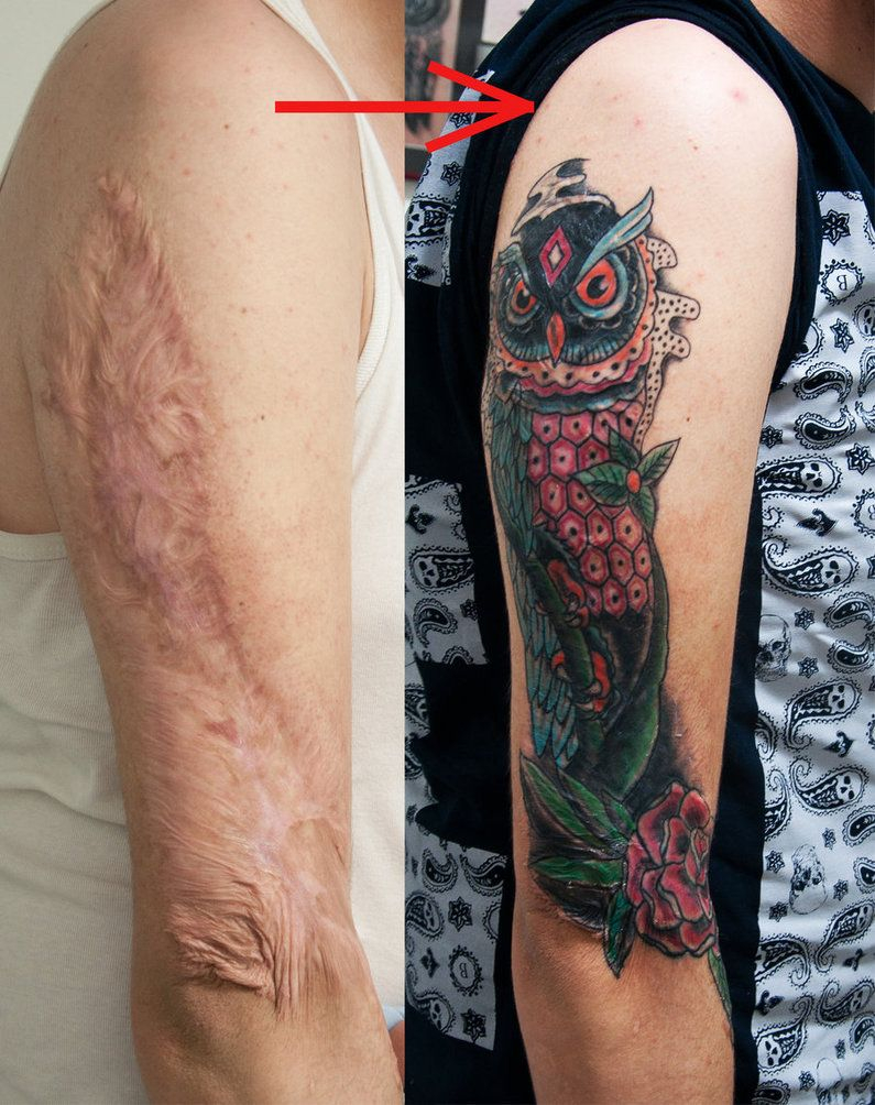 Tattoos Over Burn Scars Burn Scar Cover Healed Tattoozone intended for measurements 795 X 1004