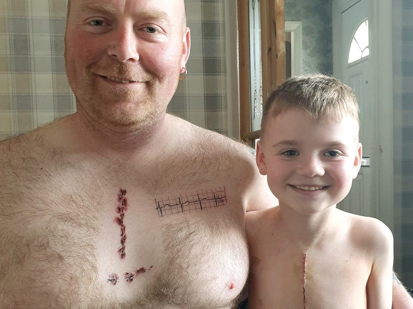 Father Gets Tattoo On Chest To Match Sons Heart Surgery Scar The with regard to size 1373 X 1030